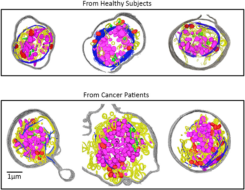 Cryo-EM images show how ovarian cancer changes platelets in a patient’s blood.